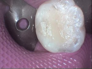 Final restoration of tooth prior to a crown